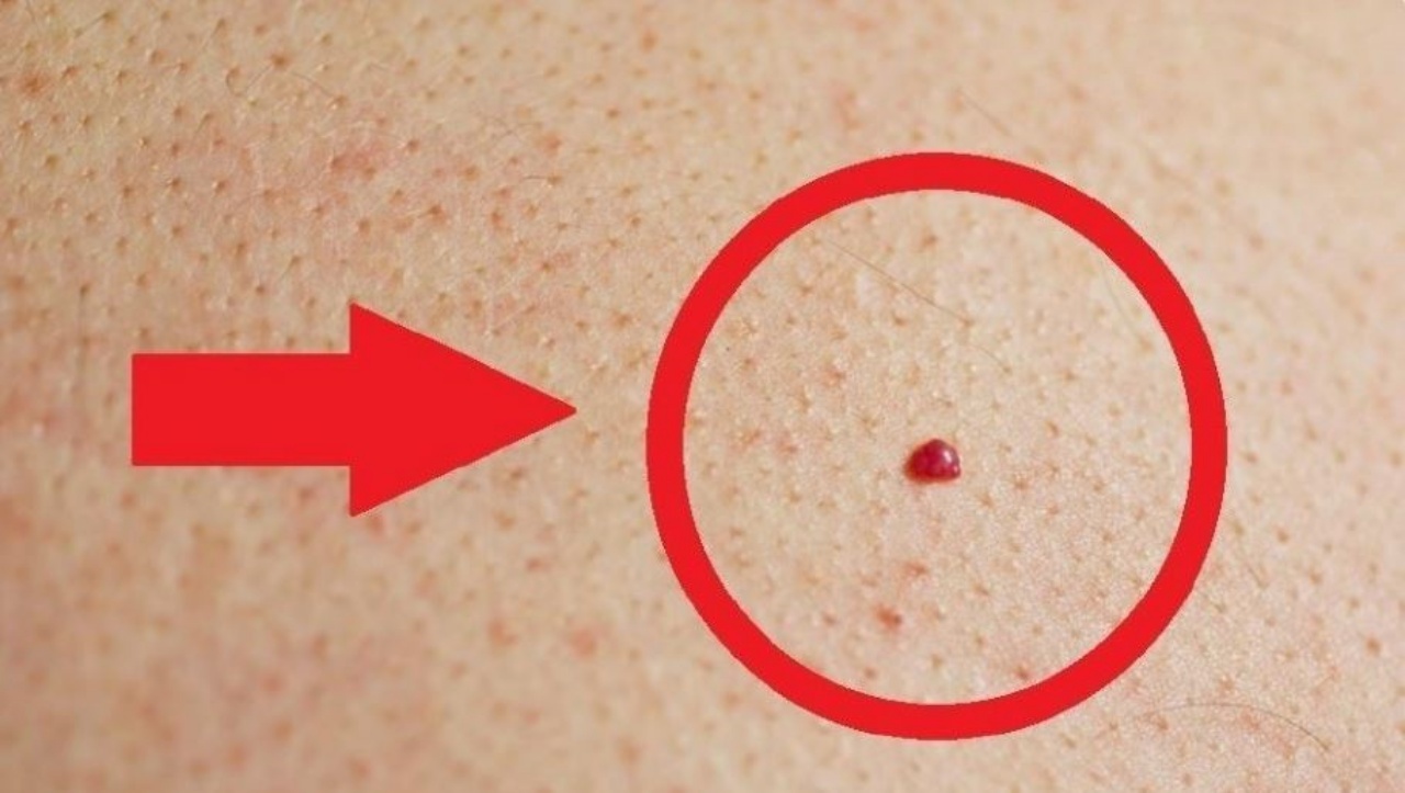 Puntos Rojos en el Cuerpo: Causas, Razones y Soluciones