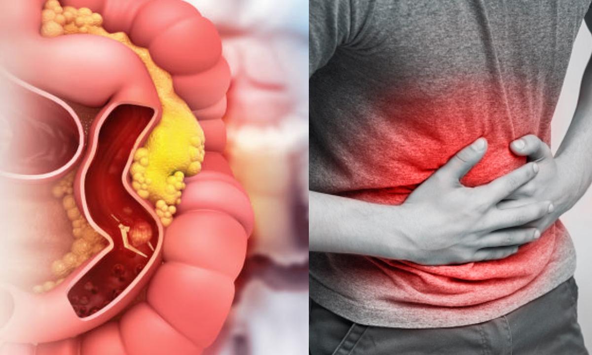 Cáncer de Colon: Una Perspectiva Detallada sobre la Enfermedad, Síntomas y Prevención