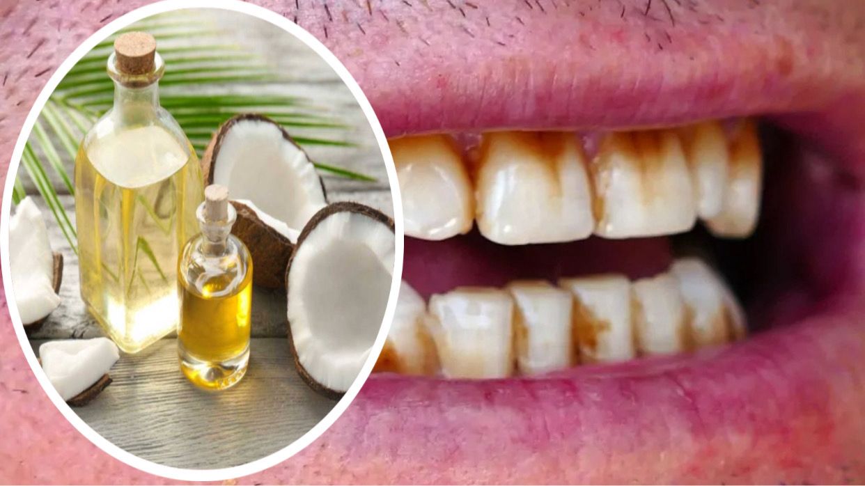 Remedios Caseros para Eliminar Caries y Sarro Dental