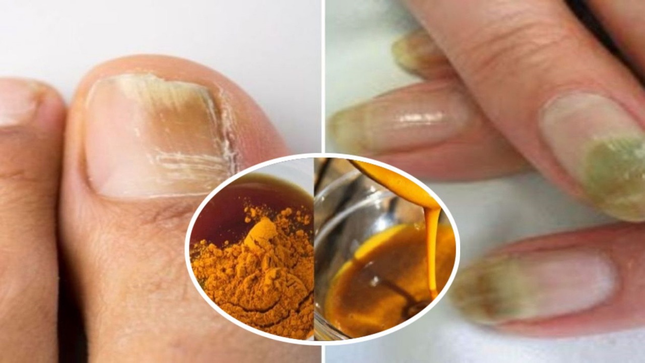 El Poder Curativo de la Cúrcuma para Combatir los Hongos de las Uñas
