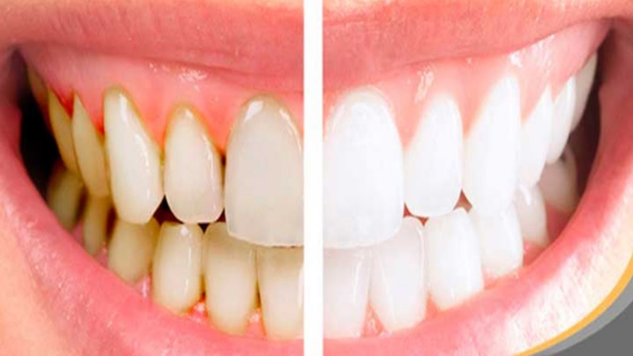4 Remedios Caseros para Eliminar el Sarro Dental