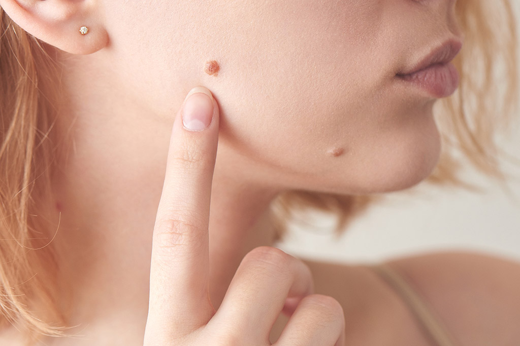 Remedios Naturales para Eliminar Verrugas, Lunares y Fibromas