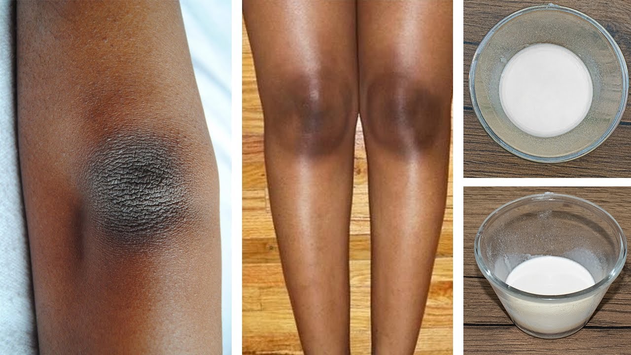 Crema Casera para Blanquear Codos, Entrepiernas y Cuello