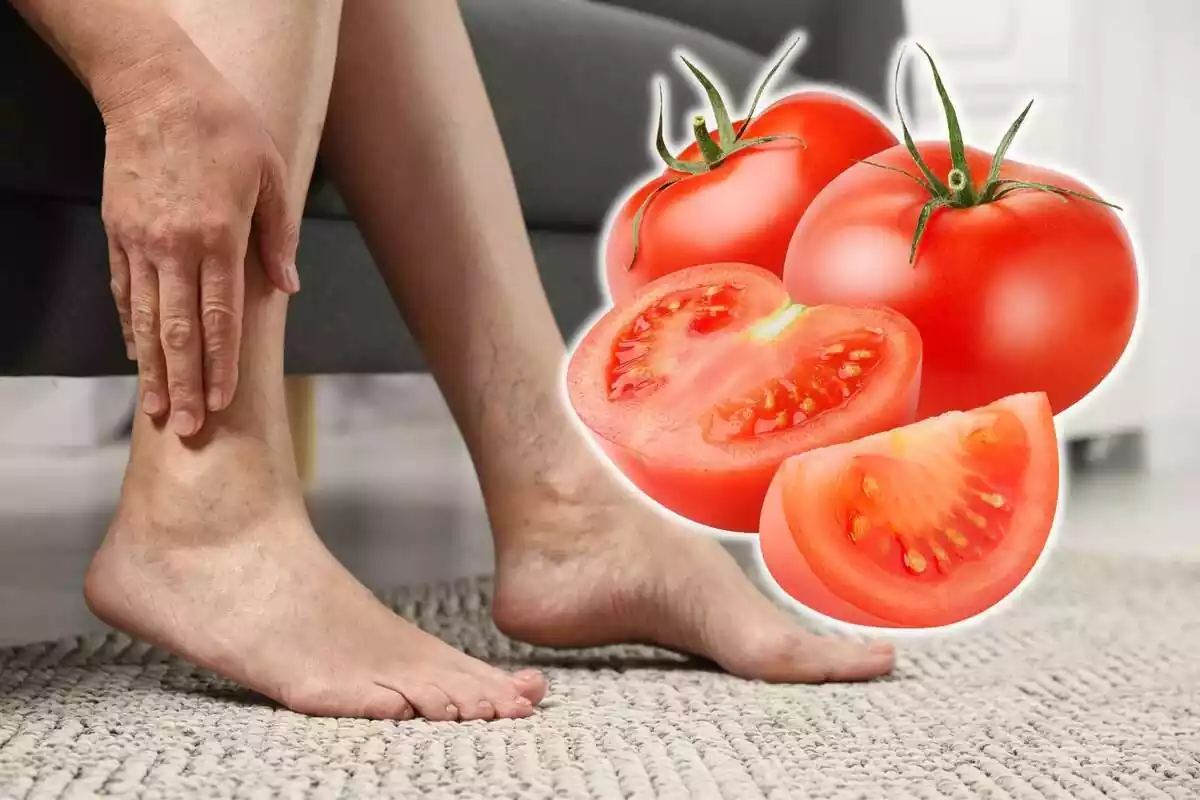 Varices