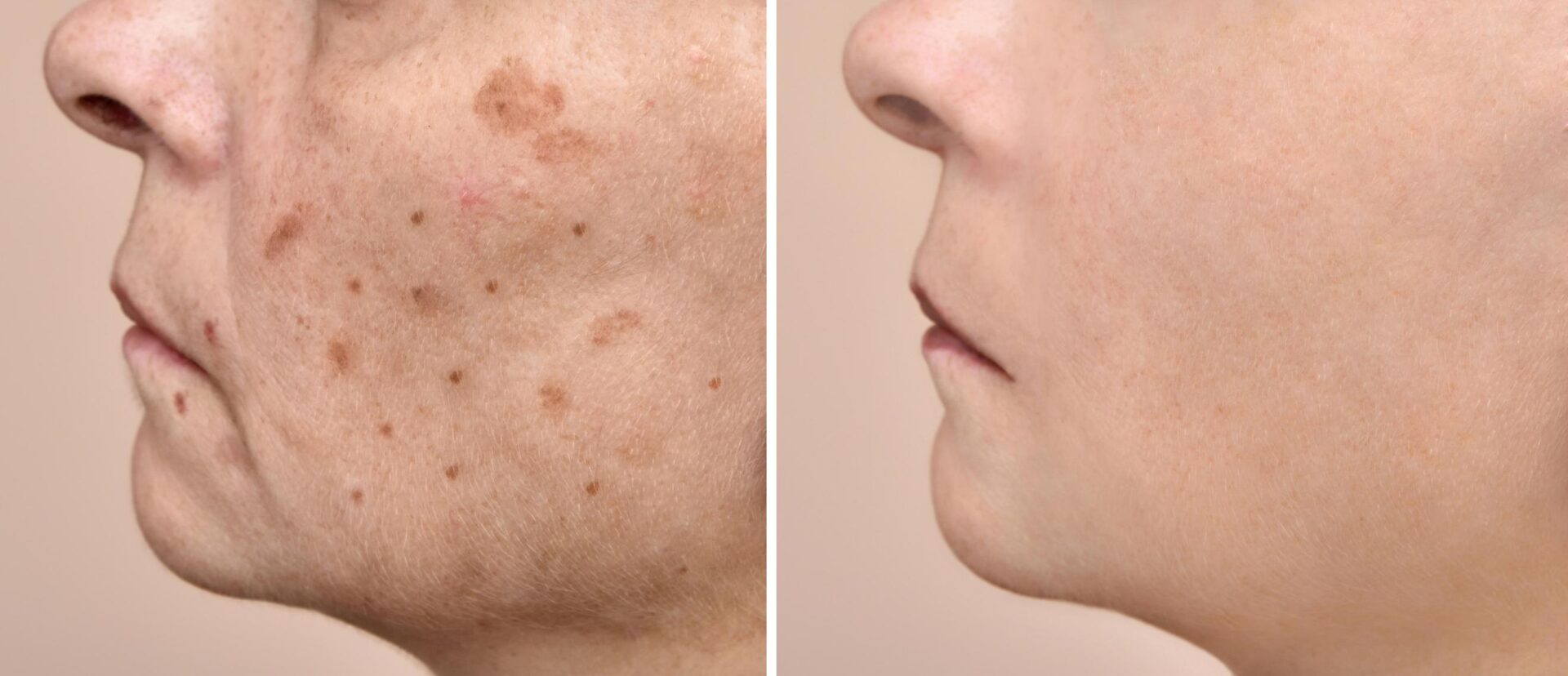 Remedios Efectivos y Recetas Caseras para Combatir las Manchas en Manos y Rostro