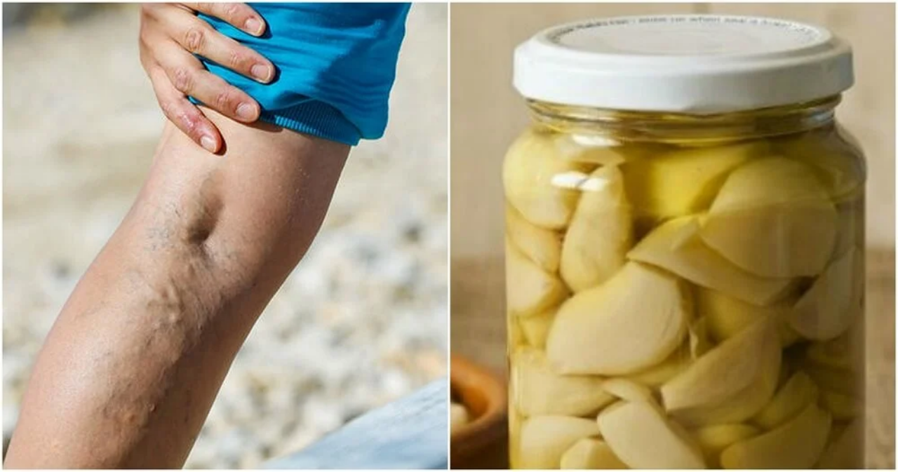 Tratamiento Natural para las Varices: Receta de Ajo, Limón y Aceite de Oliva