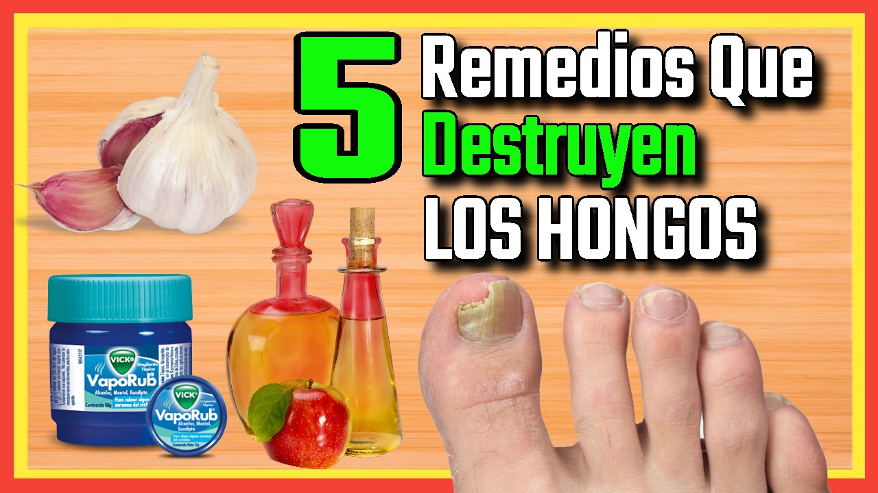 Cinco Remedios Caseros Efectivos para Eliminar Hongos en Uñas y Piel