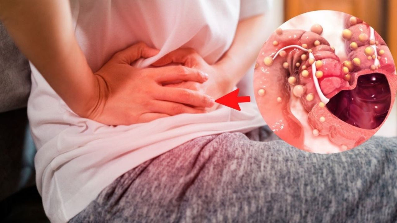 El cáncer de colon: una enfermedad silenciosa que requiere atención