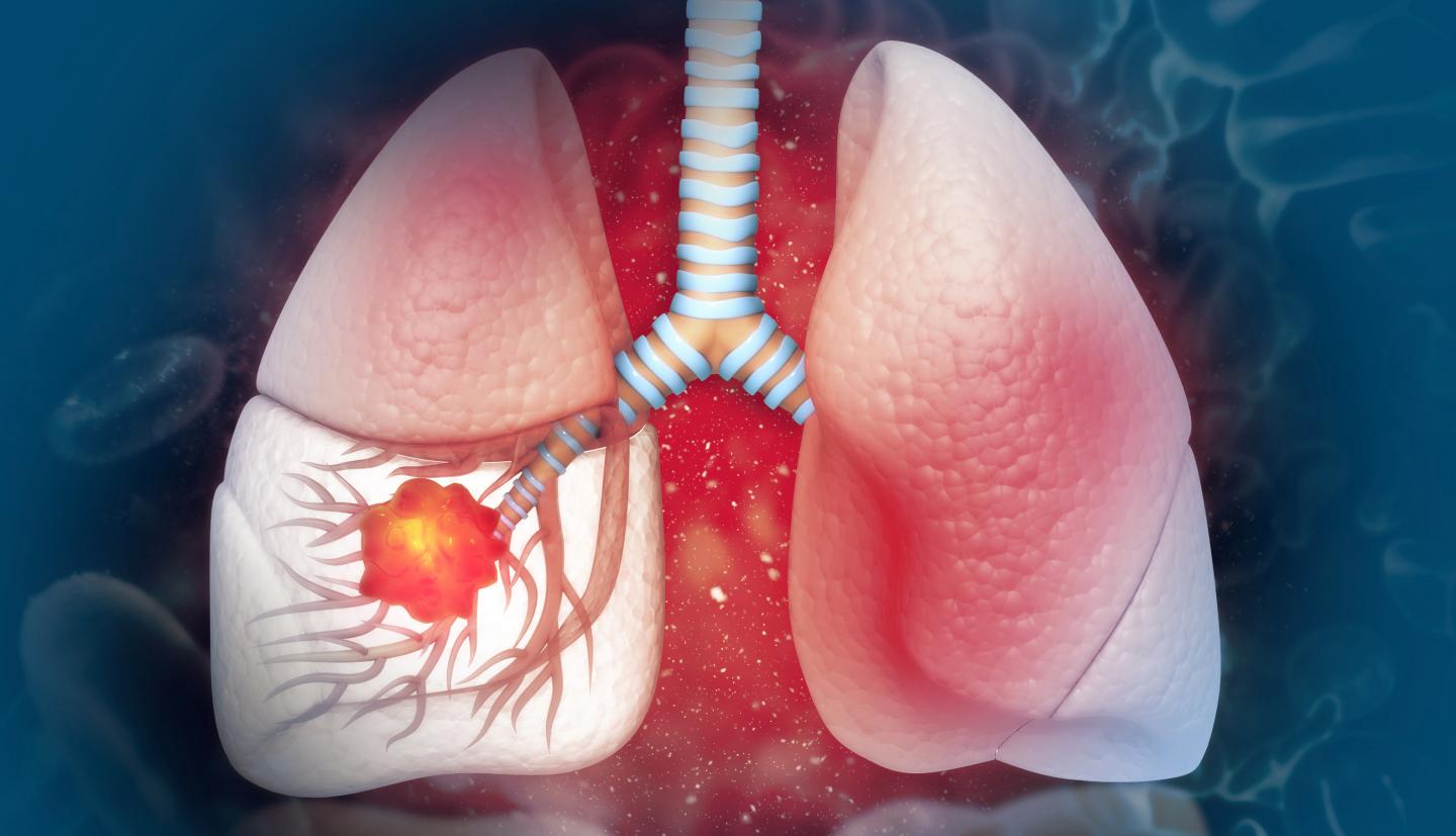 Síntomas del Cáncer de Pulmón: Consejos y Tratamientos Caseros