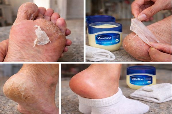 Este es el remedio que sí repara los pies agrietados y muchos ignoran